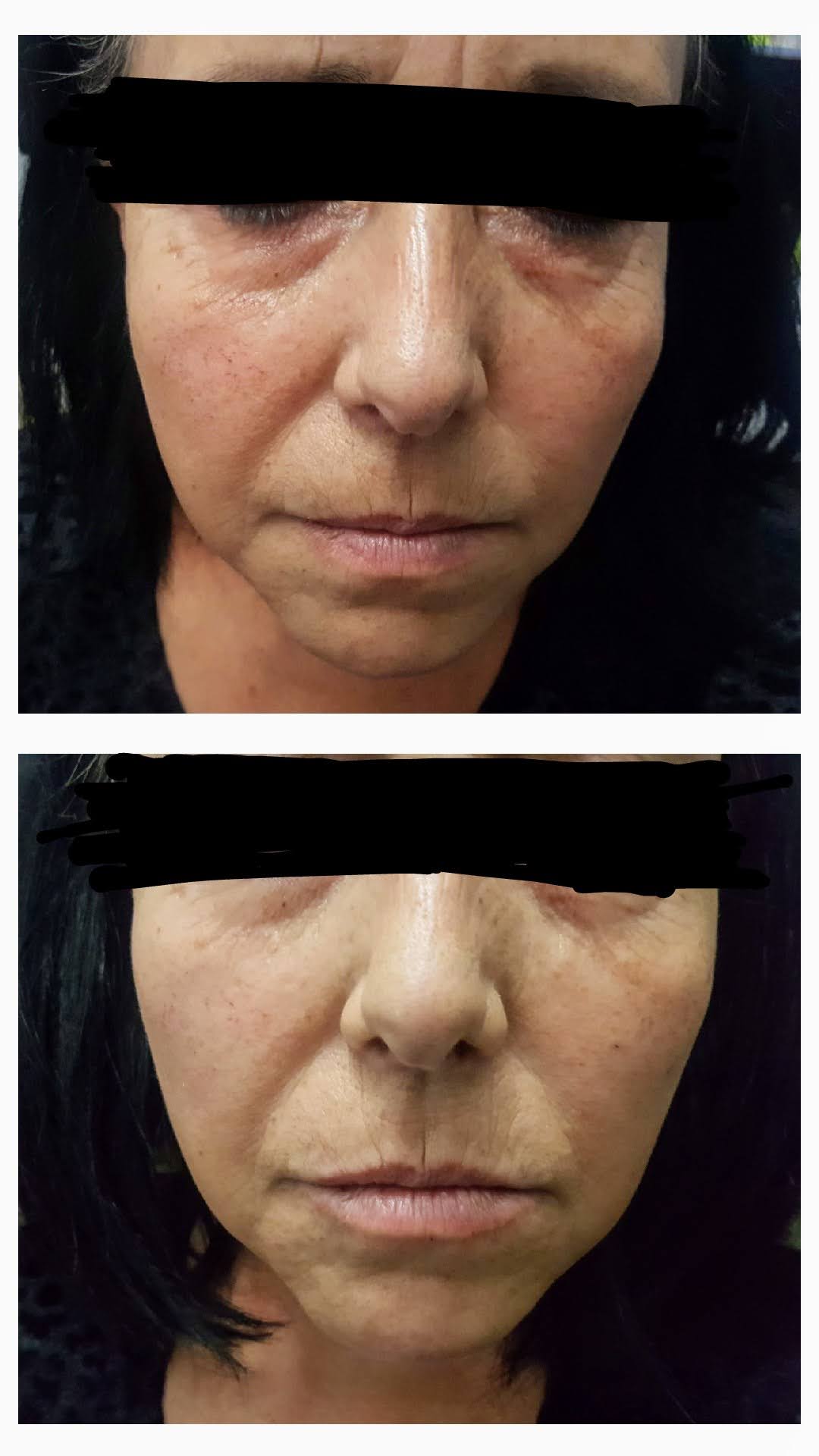 Скули- корекция на средната трета на лицето! – MM.CLINIC DERMATOLOGY