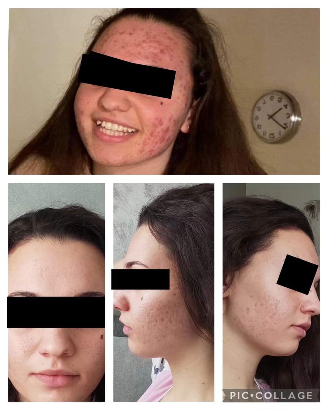Белези от акне? – MM.CLINIC DERMATOLOGY